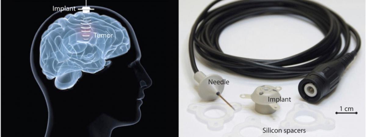 Cancer Cerveau Remission