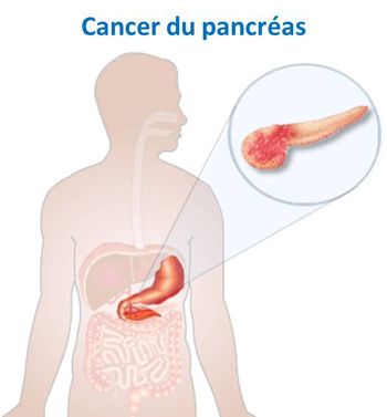 Cancer du pancréas : une nouvelle piste pour empêcher les ...