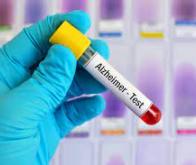 Maladie d’Alzheimer : vers un test sanguin fiable détectant des oligomères toxiques des années ...