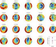 Autisme : des différences de structure découvertes dans le cerveau