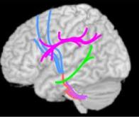 Autisme : la connectivité des aires cérébrales mise en cause ?