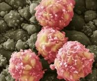 AVC : premiers résultats prometteurs d'un traitement par cellules-souches