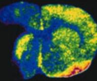 AVC : un biomarqueur pour réduire les risques de complication