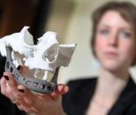 Belgique : première greffe d'une mâchoire en titane dessinée par imagerie 3D