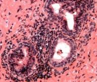 Cancer de la prostate : une avancée majeure pour prendre en charge les résistances aux traitements