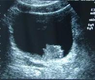 Cancer de la vessie : l’association immunothérapie-BCG améliore la survie