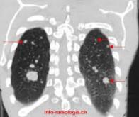 Cancer : Découverte d’un gène favorisant les métastases