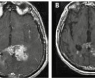 Cancer du cerveau : un espoir avec d'anciens médicaments 