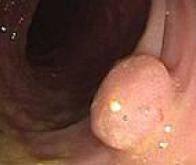 Cancer du côlon :  mieux comprendre le rôle de la flore intestinale