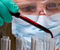 Cancer du Pancréas : un test sanguin plus précis que l'imagerie