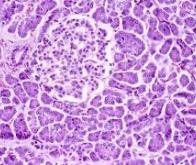 Cancer du pancréas : une nouvelle combinaison de molécules à l'essai