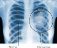 Cancer du poumon : de nouvelles avancées