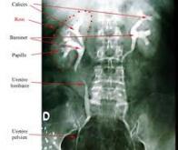 Cancer du rein métastatique : l'interruption du traitement par inhibiteurs de tyrosine kinase est ...