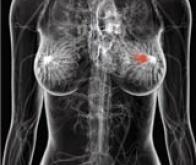 Cancer du sein invasif : quel rôle respectif pour le traitement hormonal substitutif et le ...