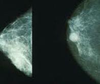 Cancer du sein : le dépistage précoce réduirait bien le risque de décès