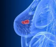 Cancer du sein : le risque augmente si un proche a un cancer de… la prostate !