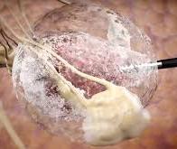 Cancer du sein : un nouveau traitement par le froid montre son efficacité sur certaines tumeurs