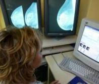 Cancer du sein : un test prédictif pour éviter la chimiothérapie