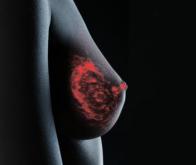 Cancer du sein : vers des thérapies sur mesure
