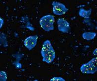 Cancer : suivre l'évolution de la maladie grâce à l’ADN tumoral sanguin