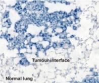 Découverte d’un nouveau mécanisme de propagation du cancer