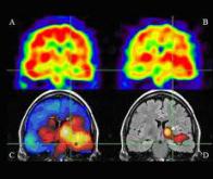 Découverte d’un nouveau mode de propagation des crises d'épilepsie dans le cerveau