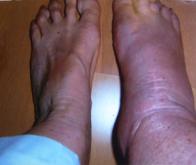Découverte d’une molécule-clé dans le déclenchement de l’inflammation