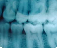 Régénérer les dents cariées grâce au laser !