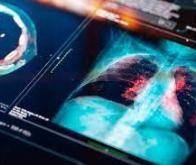 Dépistage du cancer du poumon : la détection précoce porte à 80 % le taux de survie à 20 ans