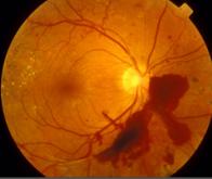 Dépister les maladies chroniques grâce à la rétine