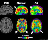 Des chercheurs britanniques déterminent la vitesse de propagation de la maladie d'Alzheimer dans le ...