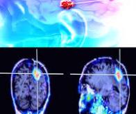 Des lasers pour améliorer la radiothérapie contre le cancer