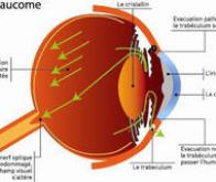 Des lentilles pour traiter le glaucome