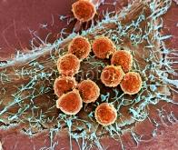 Des lymphocytes T améliorés pour détruire le cancer du pancréas