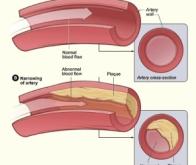 Des nano-bombes vasodilatatrices à retardement contre l'athérosclérose