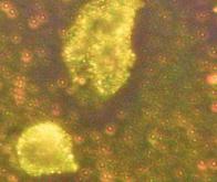 Des nanoparticules d'or contre le cancer