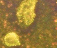 Des nanoparticules d’or inversent les symptômes dans la sclérose en plaques et la maladie de ...