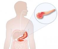 Des progrès dans la génétique de l’adénocarcinome pancréatique