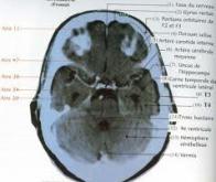 Des scanners cérébraux pour anticiper l'Alzheimer