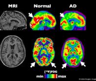 Détecter la maladie d'Alzheimer grâce aux ondes cérébrales !