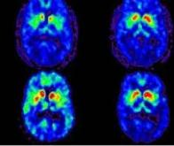 Détecter précocement la maladie de Parkinson grâce à l'IRM