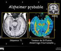 Diagnostiquer la maladie d’Alzheimer avec une seule IRM…