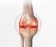 L’arthrose : un fléau mondial encore trop méconnu