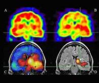 Epilepsie et autisme : une base génétique commune ?