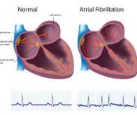 Fibrillation atriale : un anticoagulant pourrait prévenir les AVC