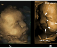 Le fœtus est capable d'exprimer des émotions sur son visage
