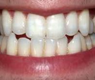 Hygiène bucco-dentaire et cancer colorectal : un lien possible...