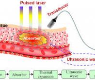 La détection photoacoustique pourrait remplacer les tests de glucose à base d'aiguille