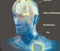 La stimulation cérébrale profonde : nouvelle arme contre l'anorexie