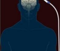 La stimulation magnétique : une nouvelle arme contre la dépression ?